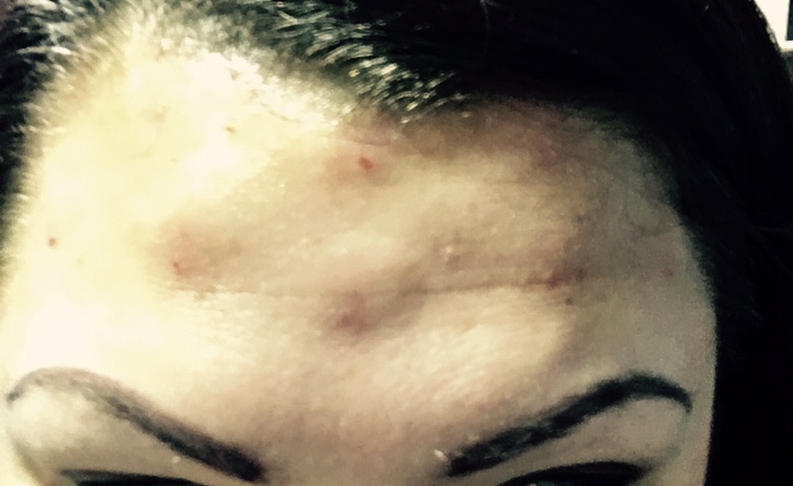 Close up of my forehead immediately after getting botox