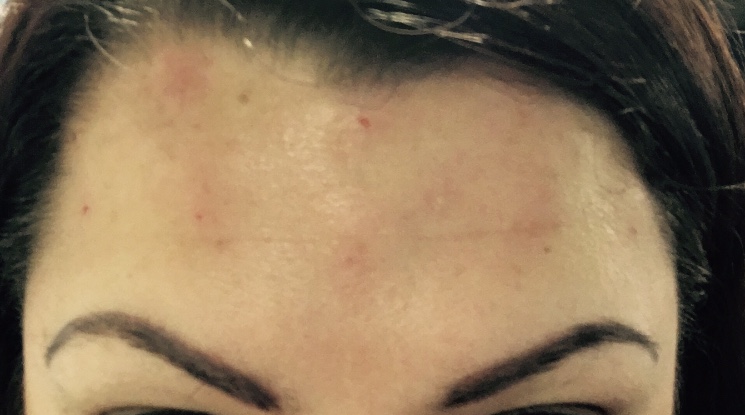 my forehead close up 15 minutes after getting botox