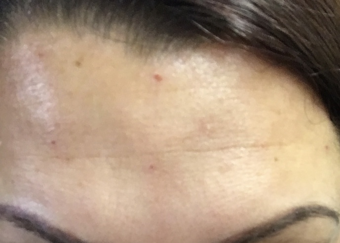 my forehead close up 30 minutes after getting botox
